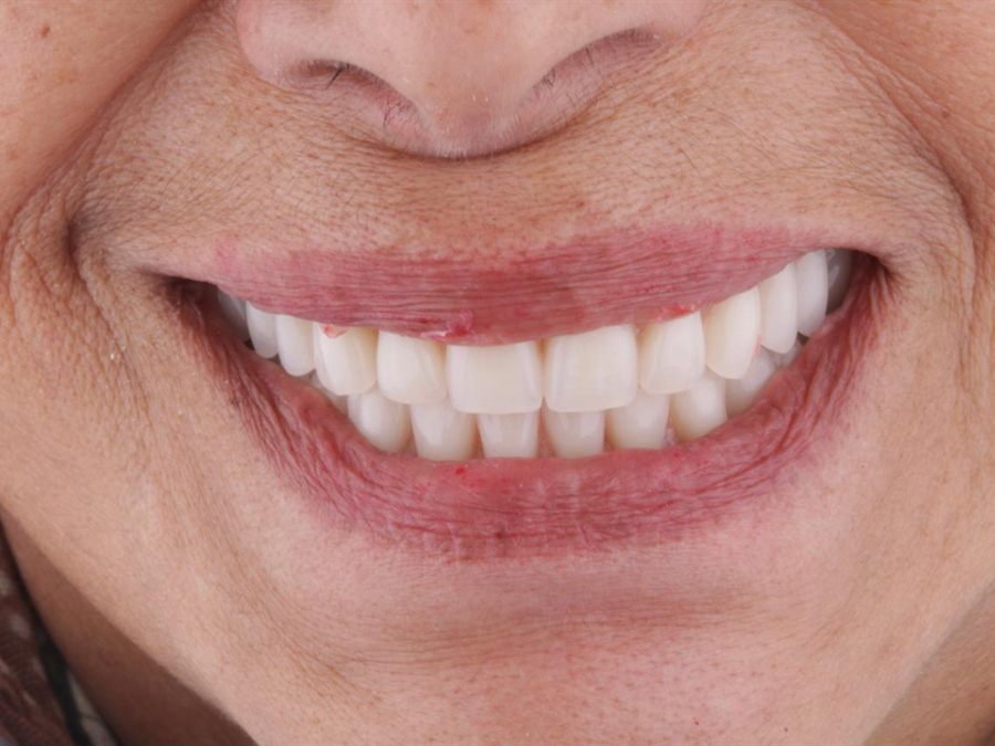 Boca del paciente después del tratamiento con prótesis sobre implantes