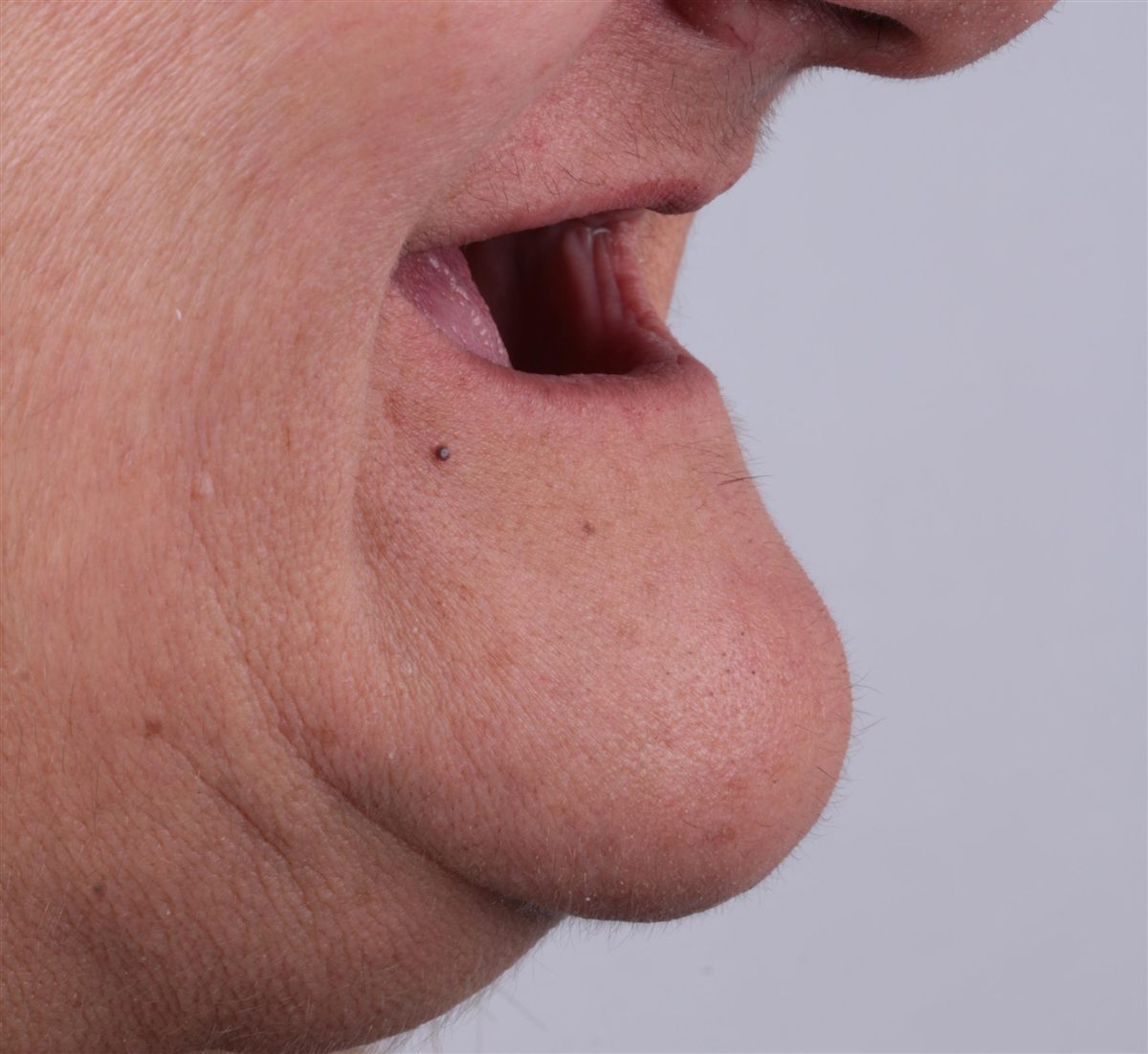 Rostro lateral de paciente con pérdida de piezas dentales